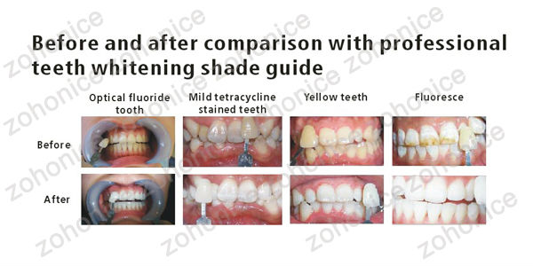 Sarı / Siyah Dişler İçin Etkili Diş Beyazlatma Makinesi Küçük Temel boyutu