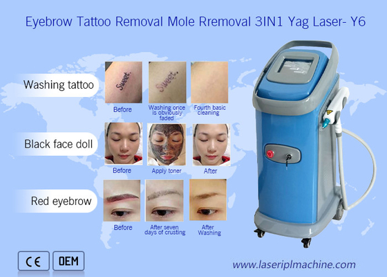 1064nm 532nm Nd Yag Lazer Dövme Kaldırma Makinesi Dermatoloji