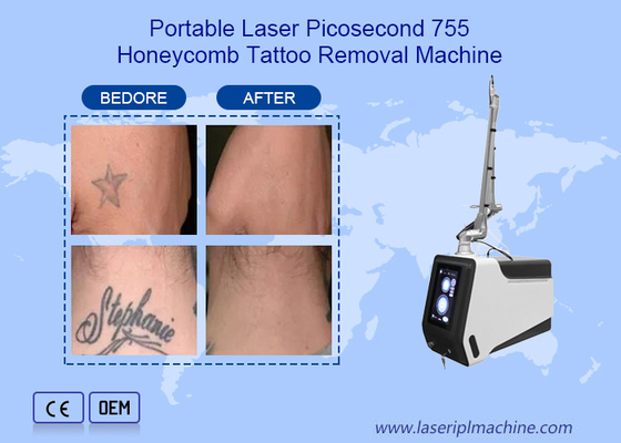 Nd Yag Pikosaniye Lazer Dövme Silme Makinesi Cihazı 755nm 1064nm 532nm